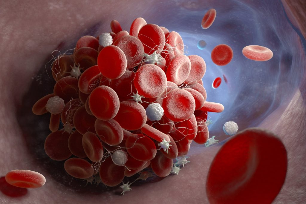 Six months after receiving Covid, risk of blood clots is higher