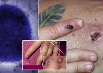 Monkeypox outbreak in the UK, Europe, and the US