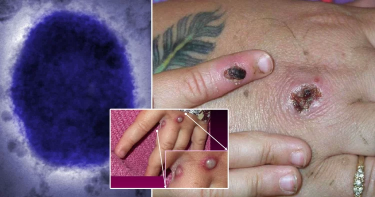 Monkeypox outbreak in the UK, Europe, and the US