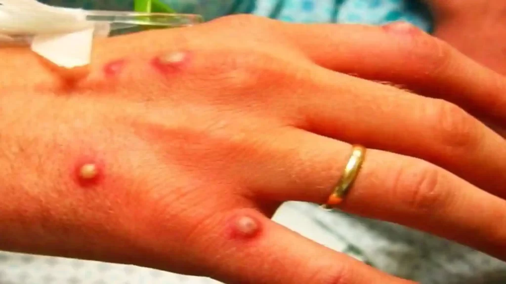 Monkeypox suspected case reported at NICH ER