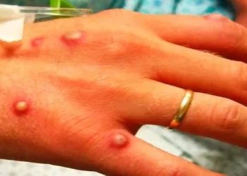 Monkeypox suspected case reported at NICH ER