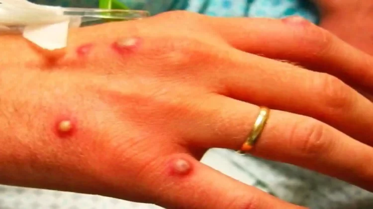 Monkeypox suspected case reported at NICH ER