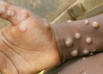 Pakistan had its first two cases of monkeypox