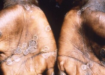 Deaths from monkeypox in the United States are uncommon
