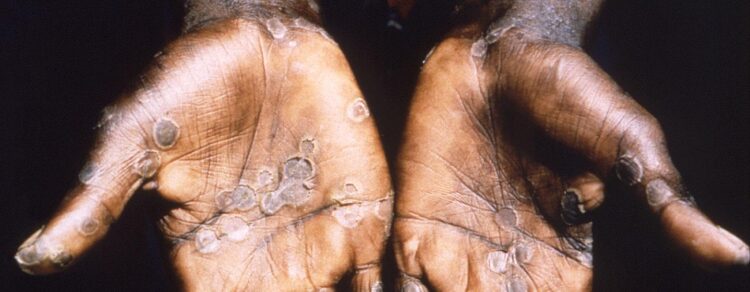 Deaths from monkeypox in the United States are uncommon