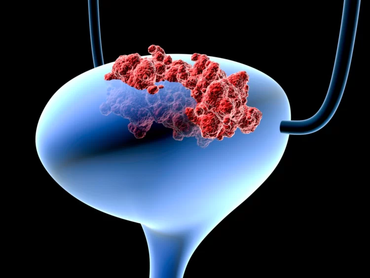 U.S has approved the 1st Gene therapy for bladder cancer