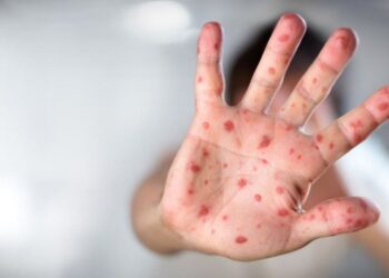 82 children are infected by the measles outbreak in Ohio, majority are unvaccinated