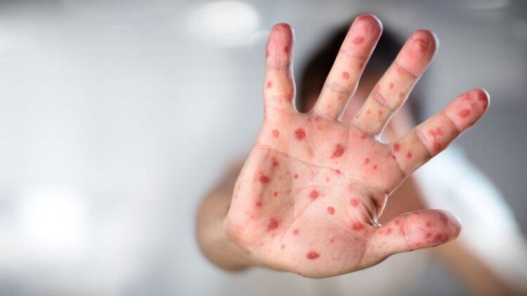 82 children are infected by the measles outbreak in Ohio, majority are unvaccinated