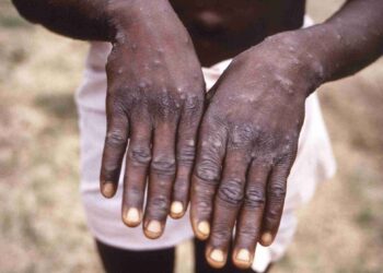 Islamabad, 2 confirmed cases of monkeypox detected