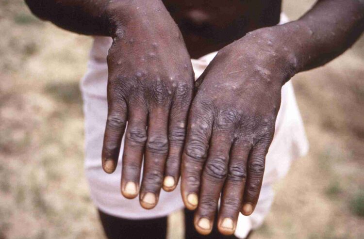 Islamabad, 2 confirmed cases of monkeypox detected