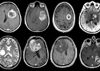 New study finds brain cancer surge in gen X