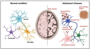 alzheimer's disease brain mechanism