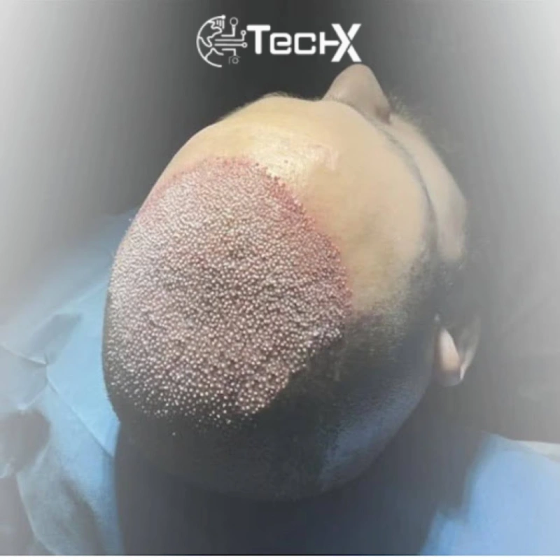 Exosomes Hair Loss Treatment at Shah Hassan Clinic
