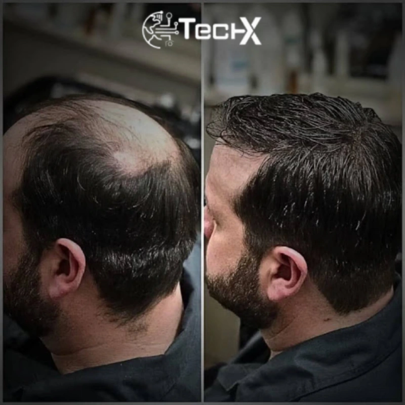 Exosomes Hair Loss Treatment at Shah Hassan Clinic